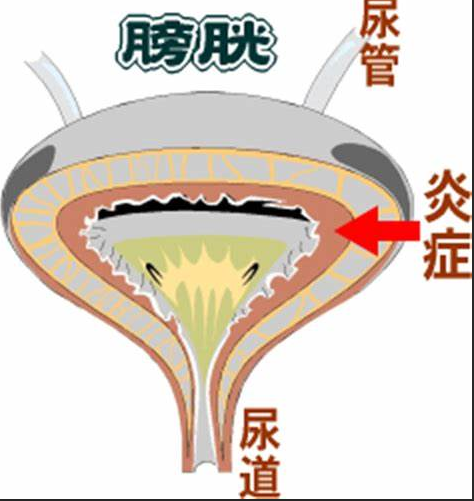 膀胱炎类型,膀胱炎症状,阜阳膀胱炎症状