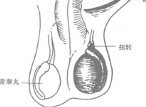附睾炎,附睾炎原因,阜阳附睾炎原因