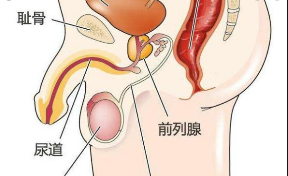 前列腺炎,前列腺炎类型,阜阳前列腺炎类型