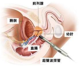 前列腺痛,前列腺痛怎么办,阜阳前列腺痛医院