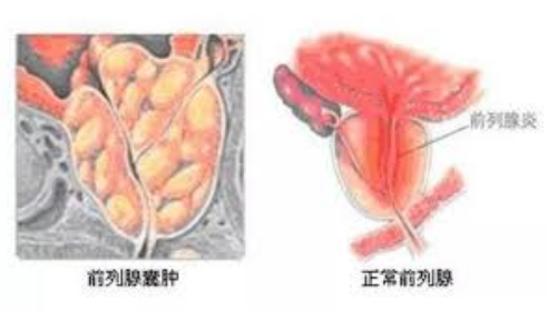 前列腺囊肿,前列腺囊肿原因,阜阳前列腺囊肿原因